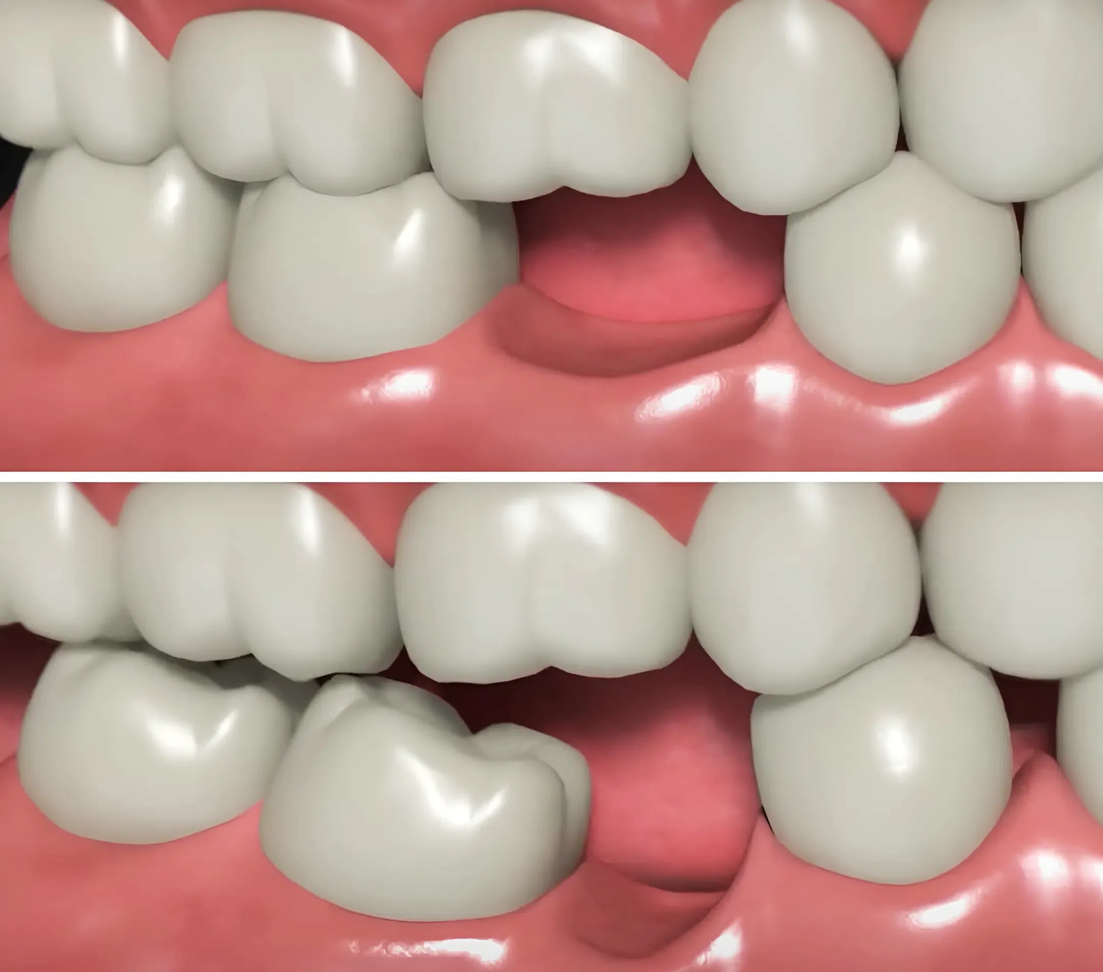 Khi mất răng lâu ngày, hai răng bên cạnh sẽ có xu hướng đổ nghiêng vào khoảng trống